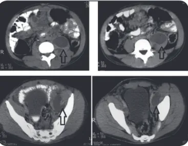 FIGURE  2  - Anatomopathological  exam:  fragments  of  colonic  and ileal  mucosa  demonstraing areas of erosion covered in ibrino-leukocyic exudate, inlammatory  iniltrate in corion, with some mulinucleated giant cells and many round-shaped yeast  (compa