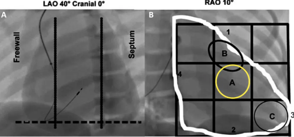 FIGURE 1 - A: 40° LAO luoroscopy with the lead in septal position. he tip of the lead is geared for the column, in a direction opposite to the freewall of the RV