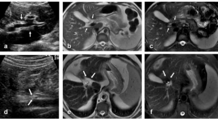 FIGURE 1 -  a) Axial opposed-phase unenhanced T1-weighted gradient-echo MRI  (TR/TE 150/2.1) shows periportal hypointense bands