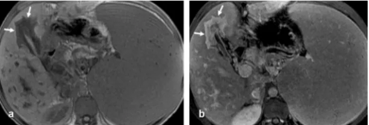 FIGURE  5  -  a)  In-phase  unenhanced  T1-weighted  gradient-echo  MRI  (TR/TE 150/2.1) discloses pericholecystic hypointense bands, suggesting  pericholecystic ibrosis