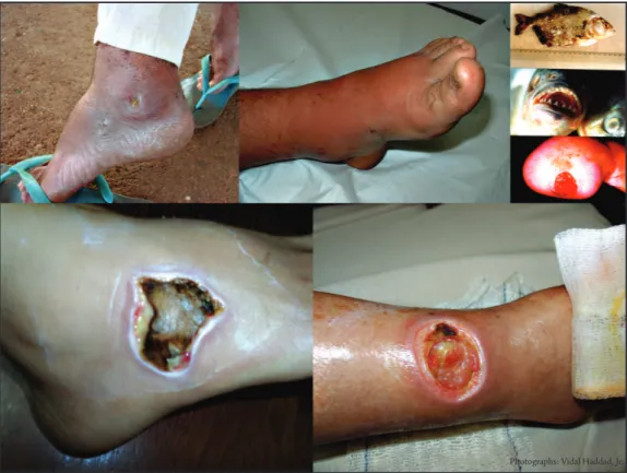 FIGURE 2 - Injuries caused by ish to ishermen in the study. Top let to right: ulcers ater a sting from a mandi;   inlammation/