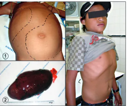FIGURE 1 - Malnutrition and hepatosplenomegaly.