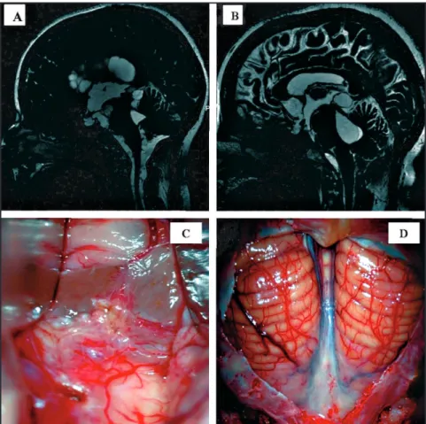 FIGURE 1: A - Sagital magnetic resonance Imaging (MRI) with a fast imaging employing steady state  acquisition (FIESTA) acquisition demonstrating inlammatory granulomatosis, aracnoiditis and cystic  lesions inside the lateral ventricles, third ventricle, p