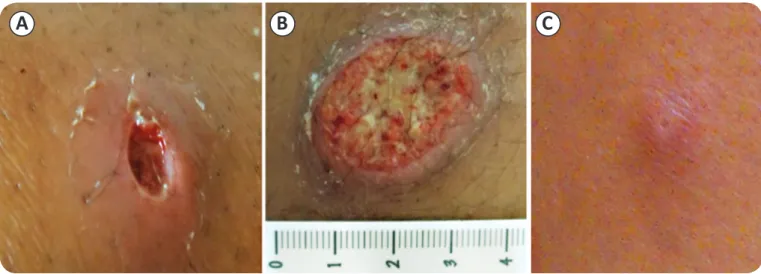 FIGURE 1 - Typical lesions caused by different clinical forms of cutaneous leishmaniasis