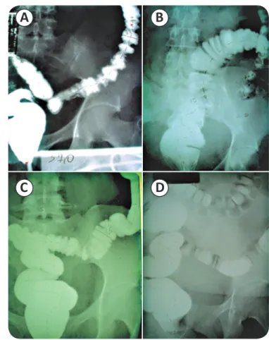 FIGURE 1 - Different morphologies of the rectosigmoid colon: increased sigmoid  caliber and length (A), increased rectum caliber only (B), increased rectum  caliber with normal sigmoid caliber (B) and (D), and elongated sigmoid (C).
