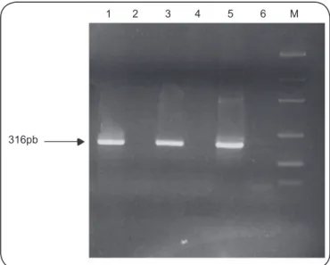 TABLE 1 - Sensitivity, speciﬁ city and positive and negative predictive values   of nested in-house PCR technique, in biological samples (blood,  urine and pleural ﬂ uid) of 37 patients with suspected pleural tuberculosis.