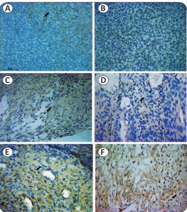 FIGURE 1 - GITR expression in HPV positive cervical lesions. a: positive  control human tonsil stained with anti-human GITR antibody; b: negative control  human tonsil - omitting primary antibody, showed no staining; c: CIN II and d: 