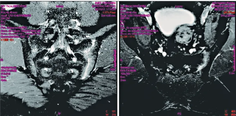 FIGURE 1 - Sacroiliitis diagnosis based on MRI. T2-weighted MRI with fat saturation, showing a hypersignal on the left sacroiliac joint and bone edema on both  the coronal and the axial planes