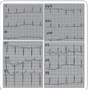 FIGURE 2 - Normal electrocardiogram.