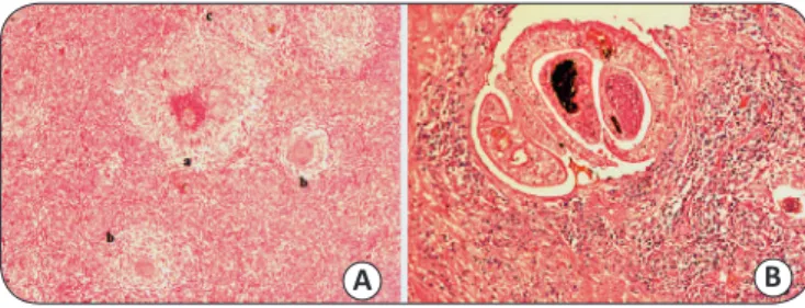 FIGURE 2 - A) Five granulomas: a) the largest in the necrotic-exudative phase,   with necrosis around the egg involved by an aggregate of epithelioid histiocytes;  