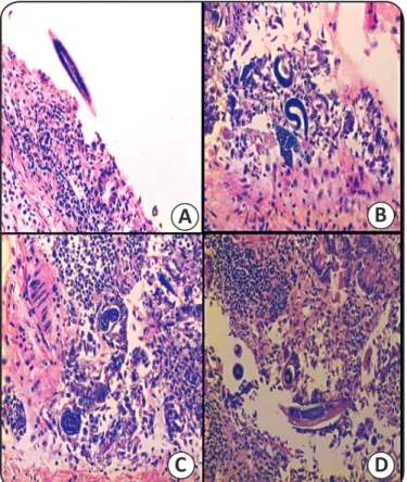 FIGURE 1 - Strongyloides worms in the gastroduodenal transition presented in  different stages of maturation (A,B,C and D), associated with an intense inlammatory  reaction and ulcerative mucosa.