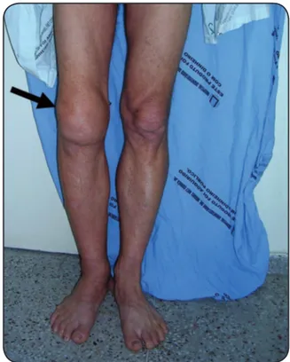 FIGURE 1 - Black row showing swelling in the right knee of the patient  with monoarthritis by Sporothrix sp