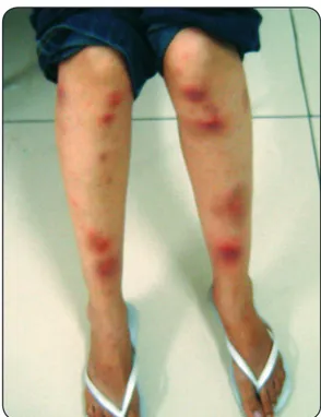 FIGURE 2 - Ulcerated, erythematous nodular lesions in right (A) and left (B) arm of  the patient with bilateral lymphocutaneous sporotrichosis (Case 2).