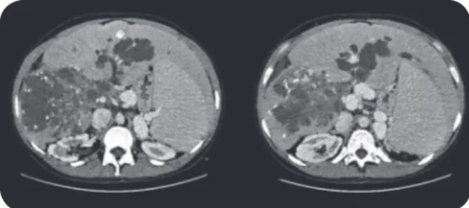 FIGURE 1 - Abdominal computed tomography scan showing multiple diffuse  cysts in the liver with peripheral calciications, affecting the hepatic hilum  and both hepatic lobes.
