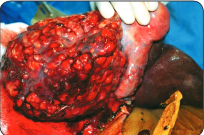 FIGURE 2 - Intraoperative view of the liver showing multiple cysts, occupying  the right and left hepatic lobes and the hepatic hilum.
