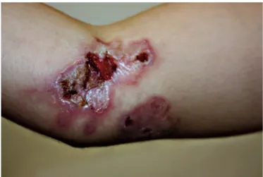 FIGURE 1 - Case 1: Ulcerative lesions on the upper limbs during  itraconazole therapy before HAART