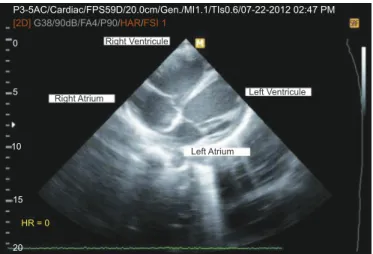 FIGURE 2 - Echocardiograph showing dilated cardiac chambers.
