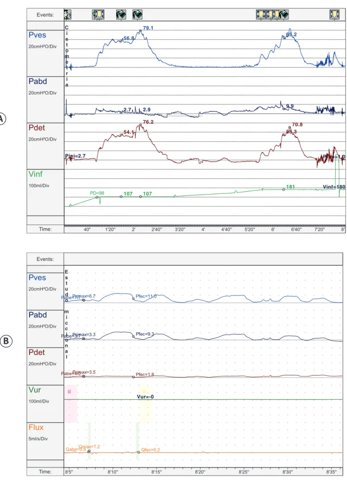 FIGURE 1  -  Urodynamic  study  of  patient  3:  Detrusor  hyperactivity  on  cystometry  and  detrusor  areﬂ exia  in  the  voiding  phase