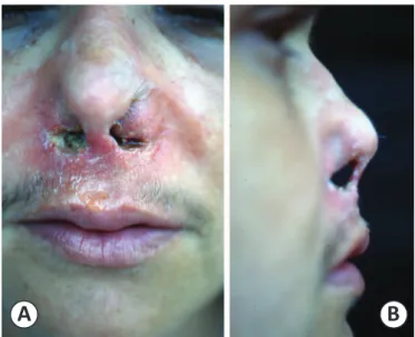 FIGURE 1 - A: Erythema and inﬁ ltration of the nose. B: A green- green-yellowish material on the nasal ﬂ oor along with septal ulceration  and perforation.