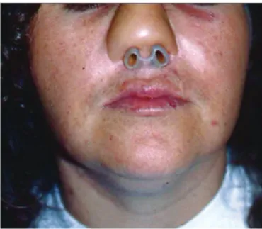 FIGURE 3 - Nasal reconstruction with a skin graft over a silicone  prosthesis showing a satisfactory esthetic outcome.