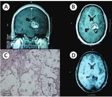 FIGURE 1 - Central nervous system cryptococcoma. T1-weighted post- post-gadolinium coronal (A) and transverse (B) MRI images revealing a 3cm x 2cm  enhancing mass in the left thalamus with central hypointensity suggestive of  necrosis