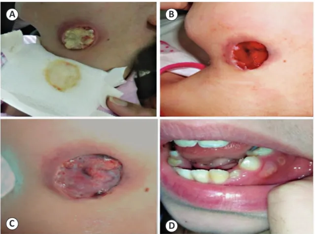 FIGURE 2 - A: Lesion after i rst biopsy. B: Lesion 2 days after second biopsy. C: Lesion 5 days after second biopsy