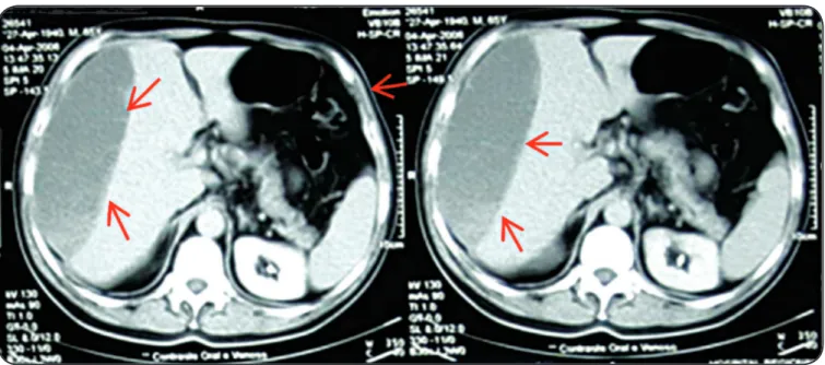FIGURE 1 - Unenhanced axial computed tomography scan shows a subcapsular hematoma in the perihepatic space (arrows)