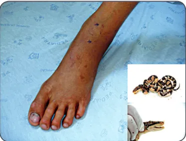 FIGURE 1 - Marks of the fangs and mild erythema and edema  in the left foot of the victim