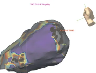 FIGURE 2 - Epicardial electroanatomical mapping of a patient  with Chagas cardiomyopathy, identifying extensive scarring  in the basolateral and apical walls of the left ventricle (gray  area)