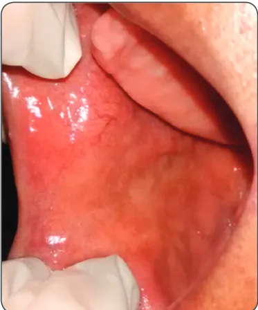 FIGURE  3  -  Buccal  mucosa  showing  no  recurrence  after  12 months of follow-up.