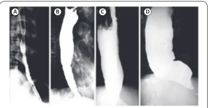 FIGURE 12. Radiologic classiication of megaesophagus. (A) Group I: The esophageal diameter is within normal limits, without food stasis, but with an  increase in food transit time from mouth to stomach