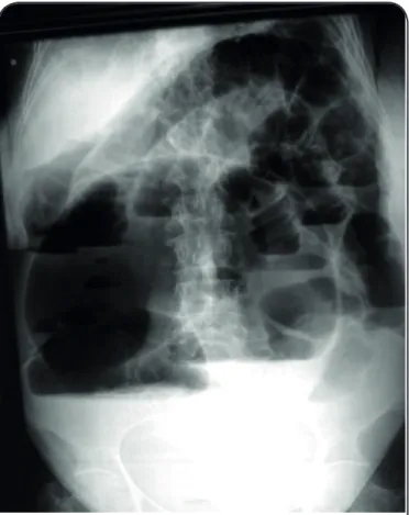 FIGURE 15. Simple radiograph of the abdomen in a case of sigmoid  volvulus. Note the anomalous position of the sigmoid caused by the dilatation  and the characteristic image of the small bowel loops secondary to the  obstruction caused by the volvulus.