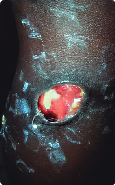 FIGURE 1. A Buruli ulcer lesion of the right lower limb showing undermined  edges.