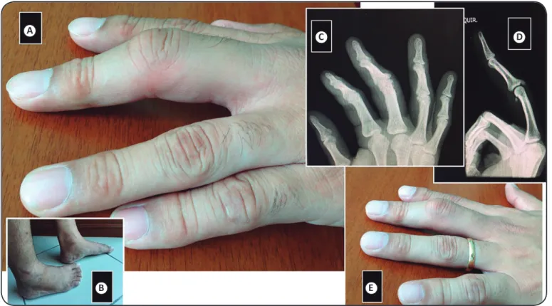 FIGURE 1. (A): Marked arthritis of the PIP joint of the middle left ﬁ nger, as seen on the third day of illness