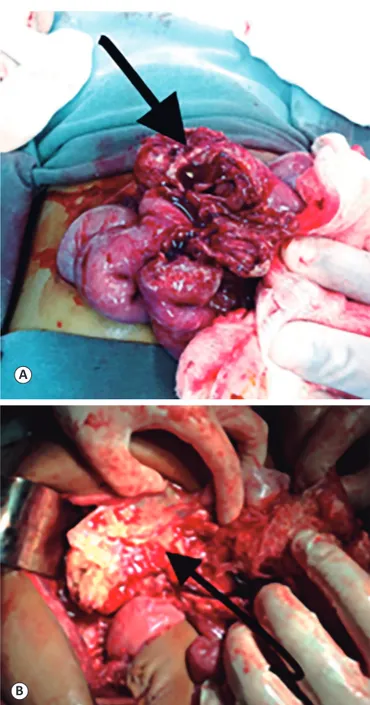 FIGURE 2. Pathological anatomy of the abdominal tumor revealing hyphae  with thick walls, chambers, and bud formation.