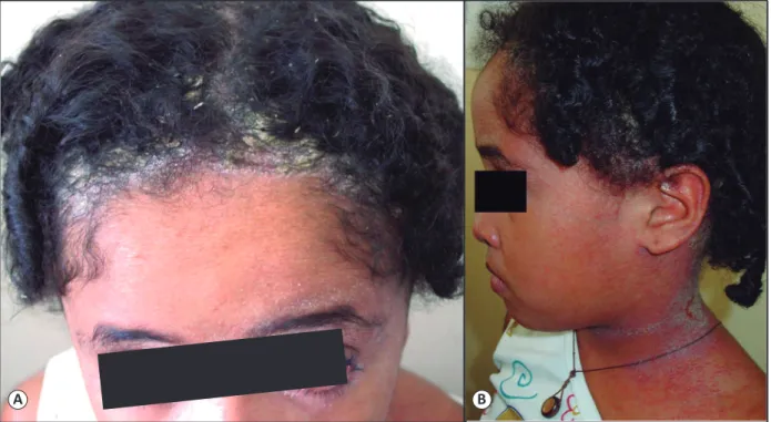 FIGURE 1. (A): Crusts on the scalp and conjunctival erythema, at the age of 7 years. (B): Crusts, erythema, and maceration on the child’s neck.