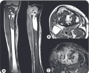 FIGURE 3. Magnetic resonance imaging of the right lower extremity at 7  months following initiation of Itraconazole therapy
