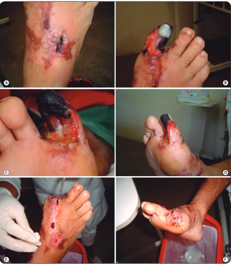 FIGURE 1 – Local complications resulting from a freshwater stingray injury. A. Darkened lesions in dorsal region of the right foot, 9 days after the  accident at admission to the reference center for tropical diseases in Manaus, Amazonas State