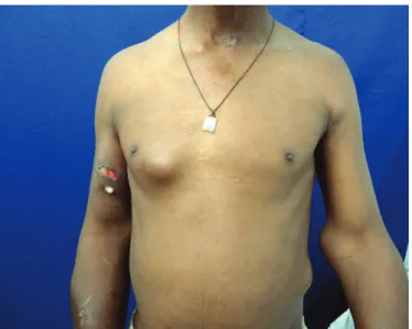 FIGURE 1  - Softened nodules and skin masses in the upper limbs, trunk,  abdomen, and cervical region.