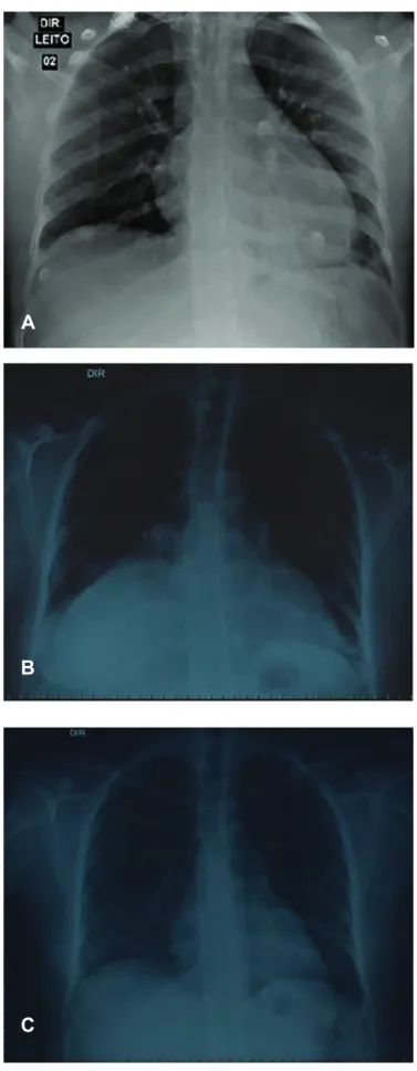 FIGURE 1 - Evolution of the chest radiograph. Increase in heart size and  absence of pleural effusion (a)