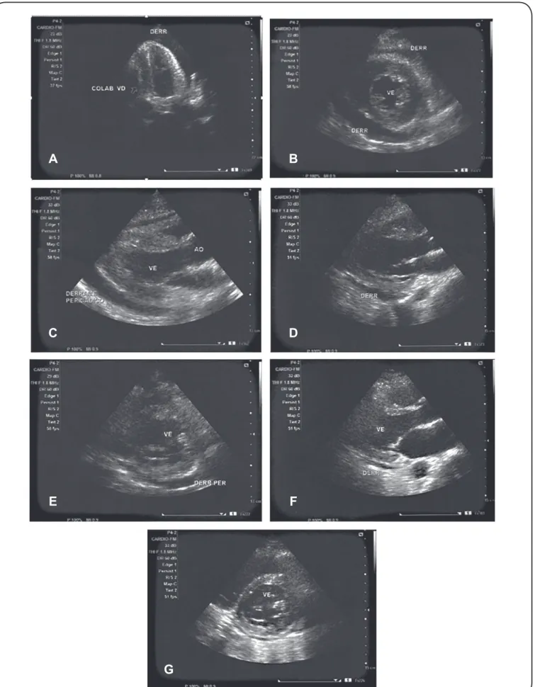 FIGURE 2 - Echocardiogram demonstrating extensive pericardial effusion with cardiac tamponade and right ventricle collapsed (a-c)