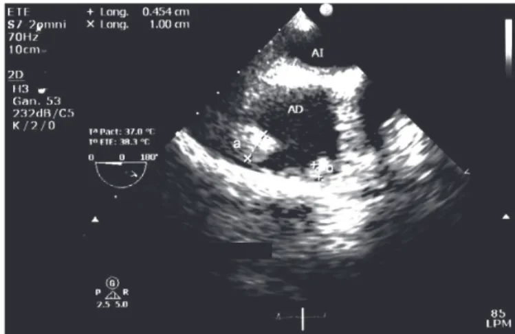 FIGURE 1 - Transesophageal echocardiogram: masses on the lateral wall of  the right atrium, measuring (a) 10  × 18mm and (b) 5 × 10mm on admission