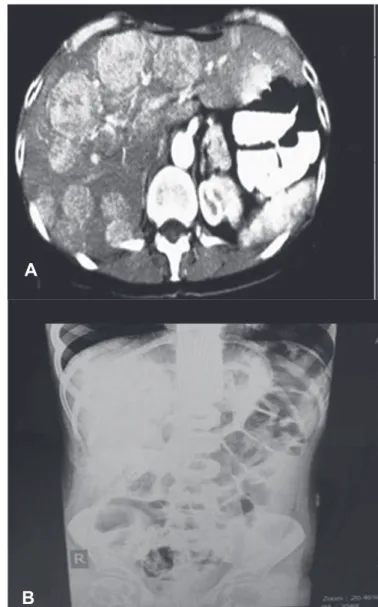 FIGURE 1 -  A: Abdominal computed tomography scan shows multiple homogenous  parenchymal densities in the liver