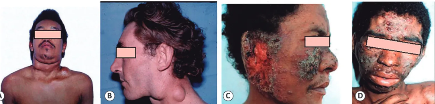 FIGURE 5  -  Patients  with  the  acute/subacute  (juvenile)  form  of  PCM. A.  Ganglionic  mass  in  supraclavicular,  cervical,  and  submandibular  region