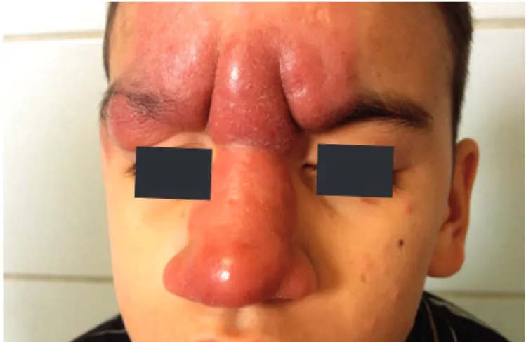 FIGURE 1 - Iniltrated erythematous plaques with precise limits and irregular  contours in the central part of the face: detail of injury