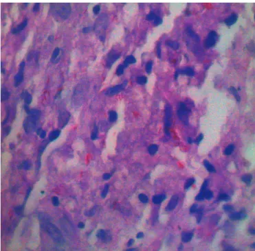 FIGURE 2 - Skin biopsy: nodular proliferation of spindle-shaped histiocytes  in the dermis.