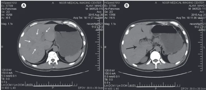 FIGURE 2 - Abdominal computed tomography scan indings. (A): Some small and tubular cysts are seen in the peripheral and subcapsular areas  of right hepatic lobe of liver (white arrows)