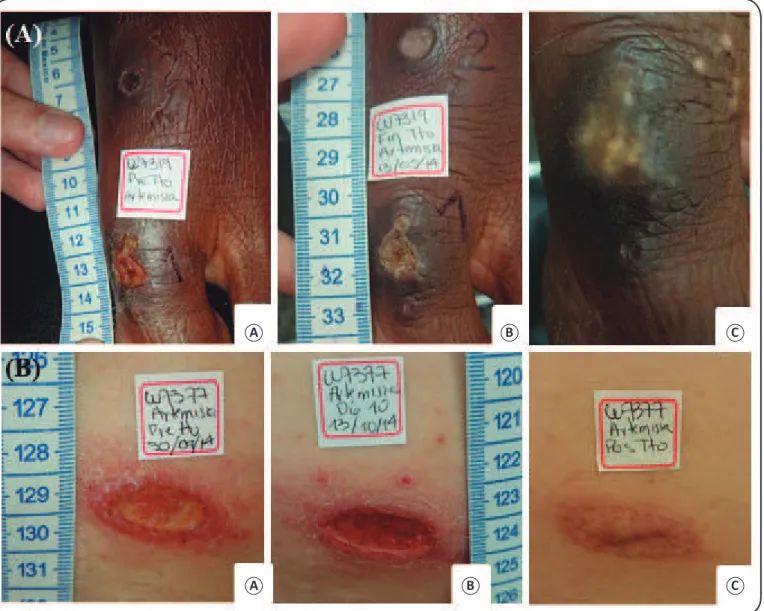 FIGURE 4. Lesion evolution in patients after treatment with Artemisia annua L. leaf powder