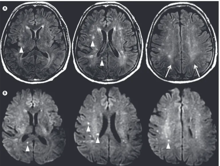 FIGURE 1 - Multiple supratentorial FLAIR (A) and DWI (B) hyperintense foci (arrowheads) distributed randomly in the white matter