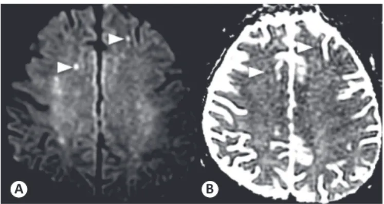 FIGURE 2 - The cortical and subcortical hyperintense foci (arrowheads)  in DWI (A) show restricted water diffusion seen as hypointense areas  on the ADC map (B)